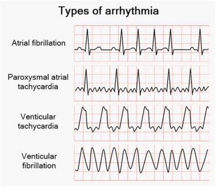 Types of Arrhythmias