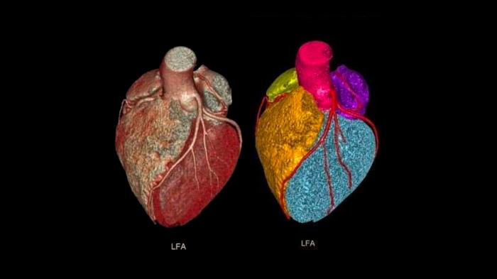 The Role of Cardiac Imaging in Minimally Invasive Tetralogy of Fallot Surgery