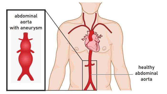 Impact of Obesity on Blood Flow and Aneurysm Formation