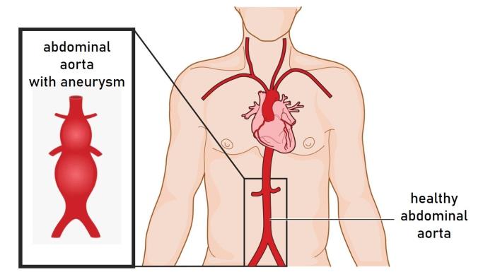 Alternative Therapies and Natural Remedies for Abdominal Aortic Aneurysm Symptoms