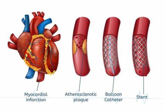 Dietary Recommendations for Diabetics After Angioplasty