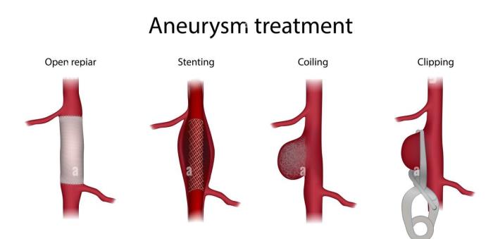 Treatment Options Based on Aneurysm Size