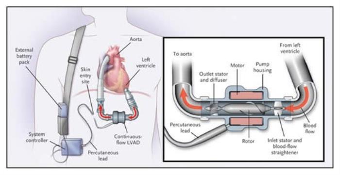 How LVAD Surgery Helps Improve Quality of Life for These Patients