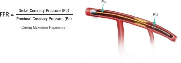 Role of Fractional Flow Reserve (FFR) in Assessing Blockages