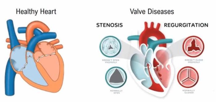 How Cardiologists Assess the Severity of Valve Problems