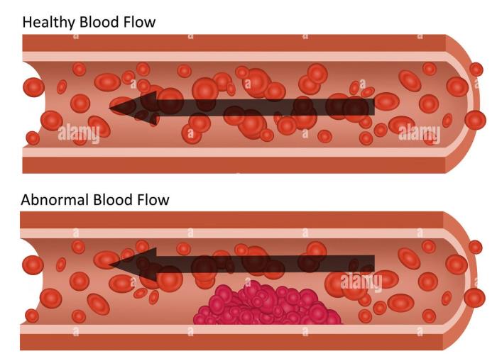 The Role of VSD Surgery in Correcting Abnormal Blood Flow