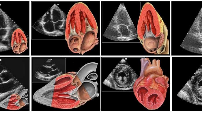 Transthoracic Echocardiogram 