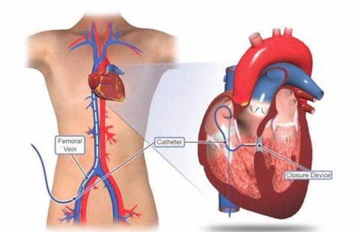 Long-Term Benefits of Improved Blood Flow After VSD Repair