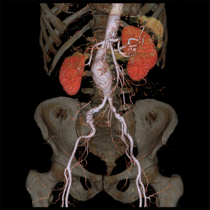 How Radiology Contributes to Abdominal Aortic Aneurysm Diagnosis