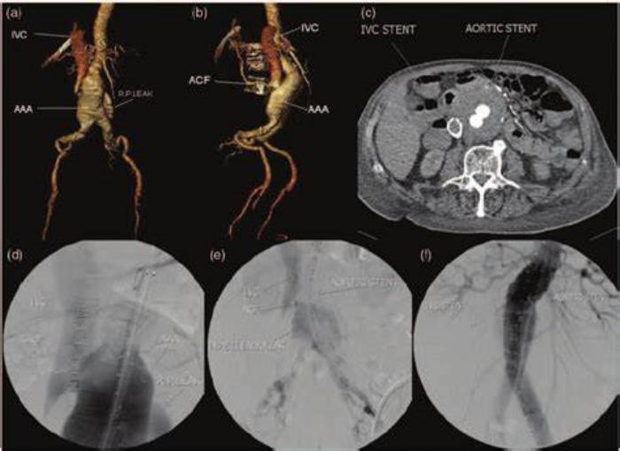 The Role of Angiography in AAA Diagnosis and Treatment Planning