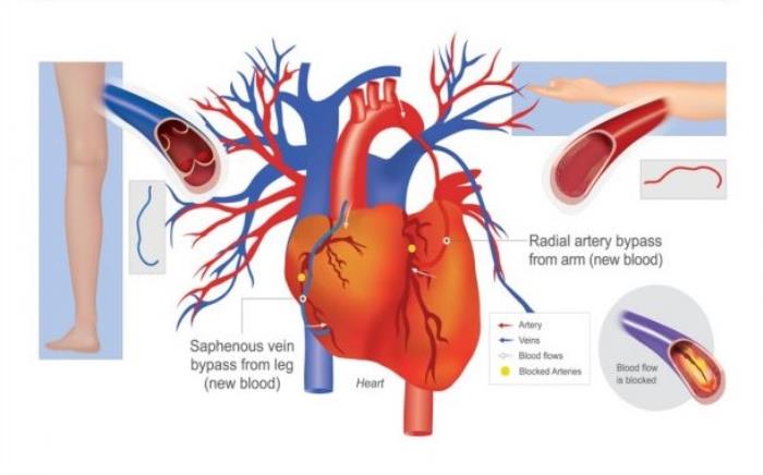 Heart Bypass Surgery Treatment Options in India