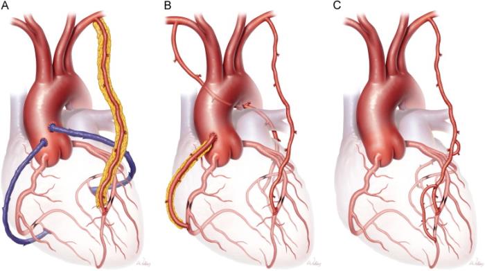 Difference Between Bypass Surgery and Open Heart Surgery?