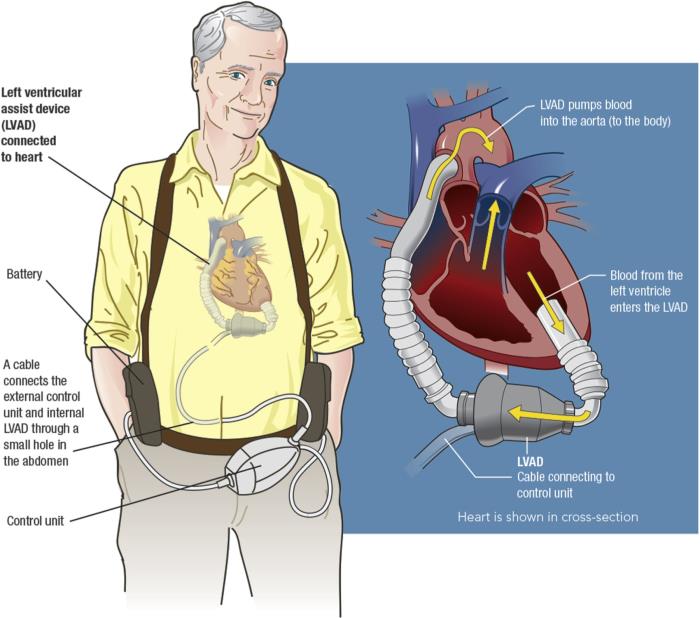 LVAD Device work