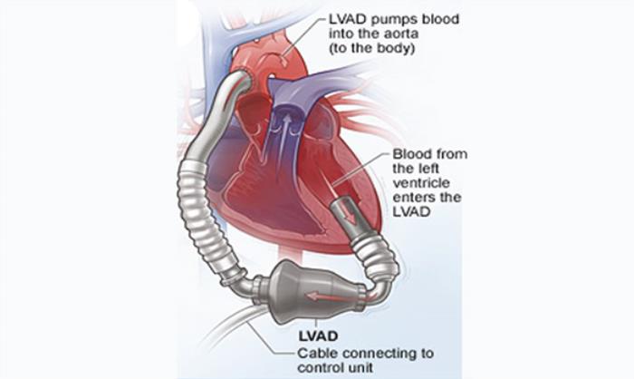 Best LVAD Surgery treatment in India