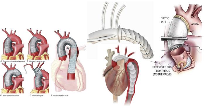 Heart Valve Replacement Surgery Treatment Options in India