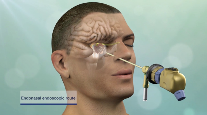 Minimally Invasive Techniques Used in Brain Tumor Surgery