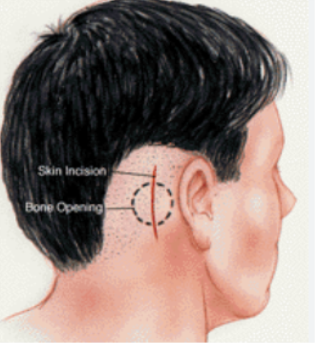 How to Minimize Scarring and Recovery Time after Trigeminal Neuralgia Surgery