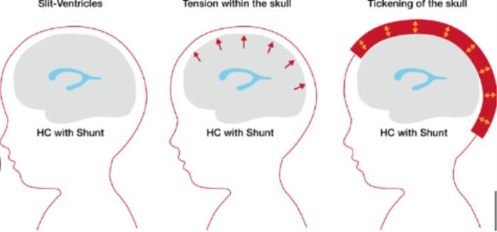 Innovations in Hydrocephalus treatment, Hydrocephalus treatment in India