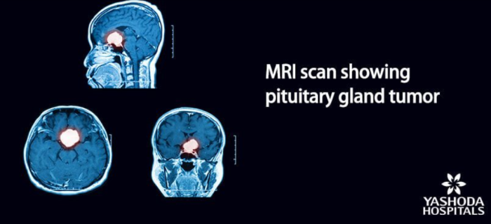  Role of Imaging and Advanced Diagnostics in Pituitary Tumor Surgery in India