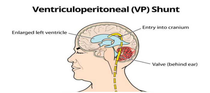 Hydrocephalus surgery legal considerations