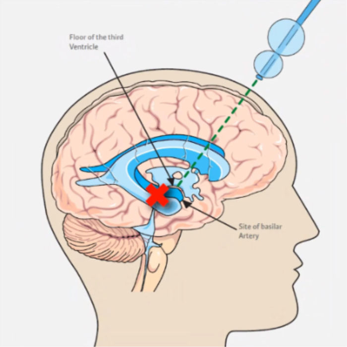 Endoscopic Third Ventriculostomy (ETV) for Adults