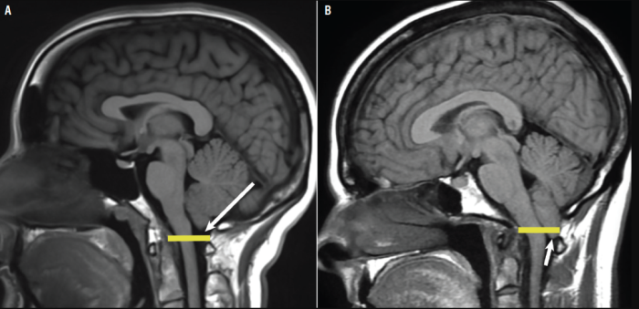 Chiari Malformation Affects the Nervous System