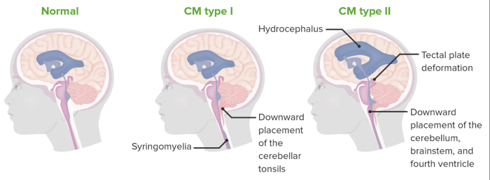 Types of Chiari Malformations