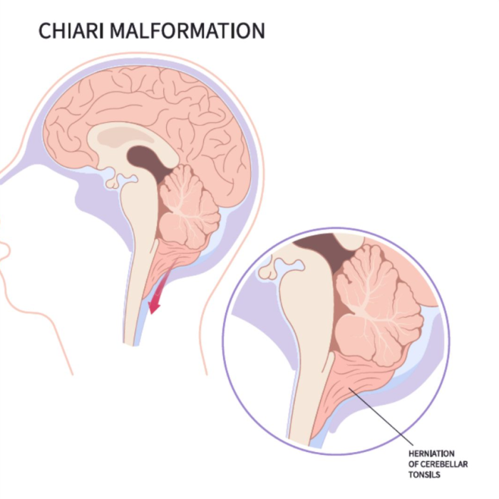 The Impact of Chiari Malformation on Quality of Life