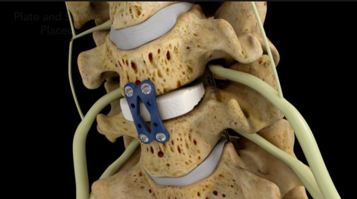 What Is Spinal Fusion Surgery and How Does It Work