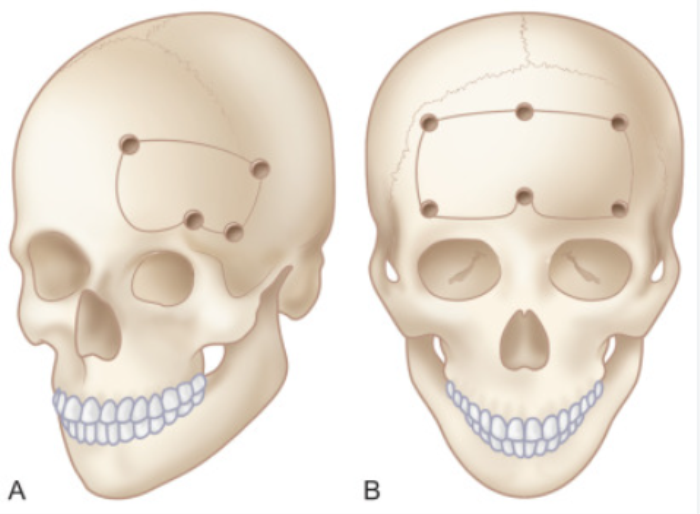 Cerebrospinal Fluid (CSF) Leaks: Indications for Skull Base Surgery