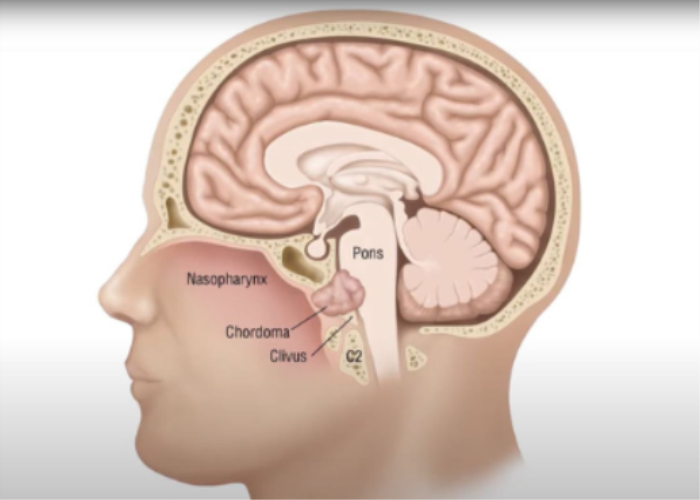 Common Skull Base Disorders