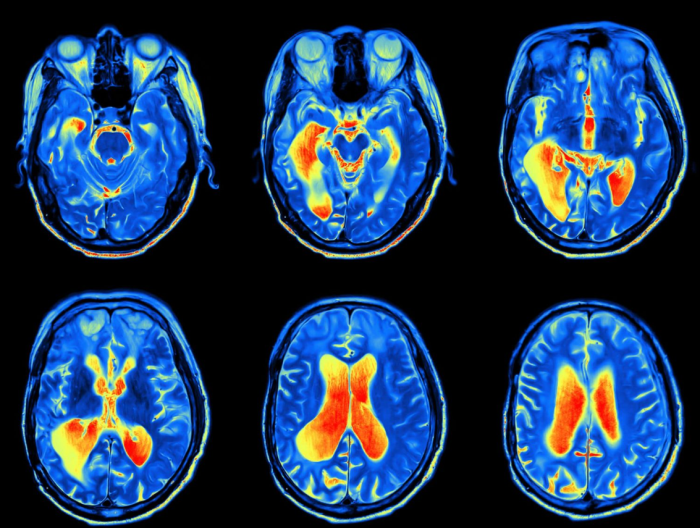 The Role of Watchful Waiting in Managing Skull Base Tumors