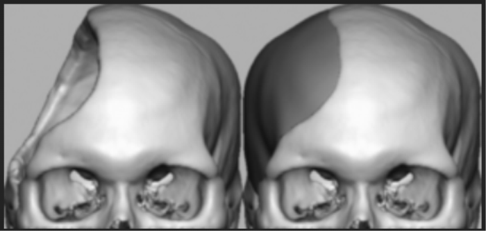 Congenital Skull Defects: Correcting Abnormalities with Cranioplasty