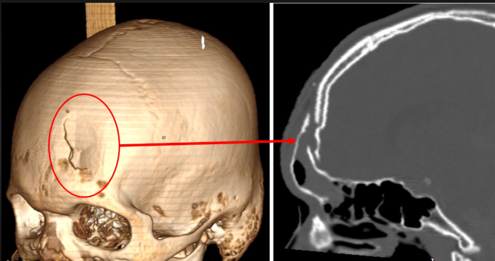 Non-Surgical Pathways: Are They Effective for Skull Injuries?