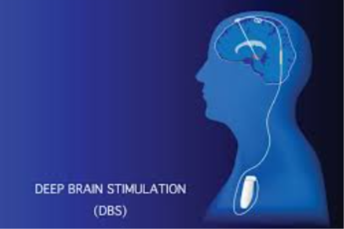 Introduction to Deep Brain Stimulation and Movement Disorders