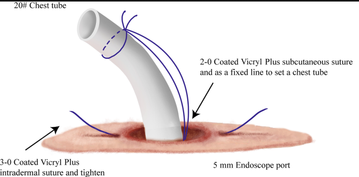 The Role of Drains and Stitches in Cranioplasty Recovery