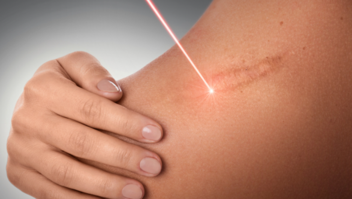 Laser Treatments: An Effective Scar Management Option