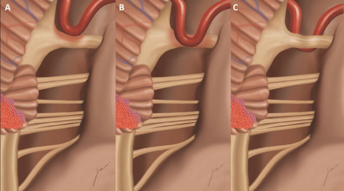 Arterial Compression of Cranial Nerves: A Primary Factor in MVD