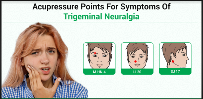 Acupuncture as a Pain Management Strategy for Trigeminal Neuralgia