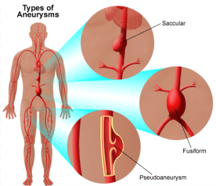 Types of Aneurysms and Their Differences