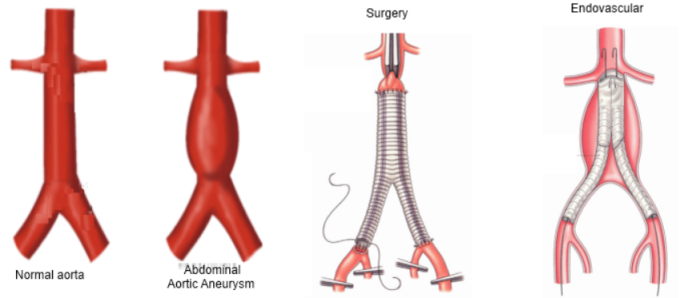 What is Aneurysm Repair Surgery?