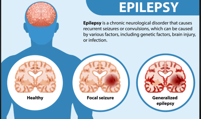 What is Epilepsy