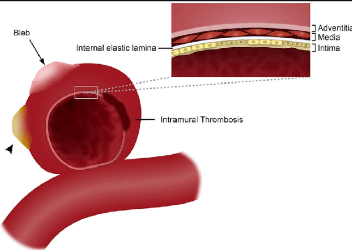 Anatomy of Aneurysms: Understanding Blood Vessel Structure