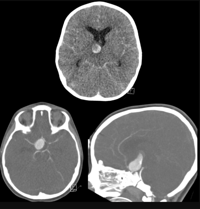 Imaging in Pediatric Aneurysm Cases