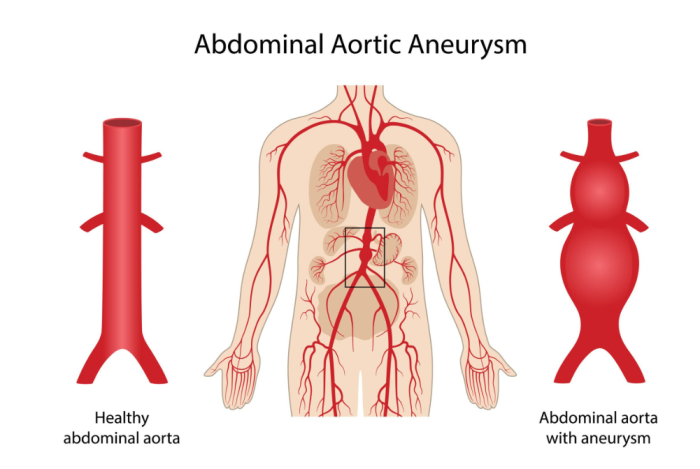 When Does an Aneurysm Become Dangerous?