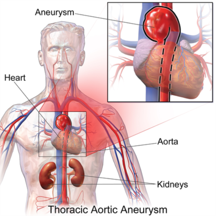 Blood Clots and Aneurysms: When Surgery is the Only Option