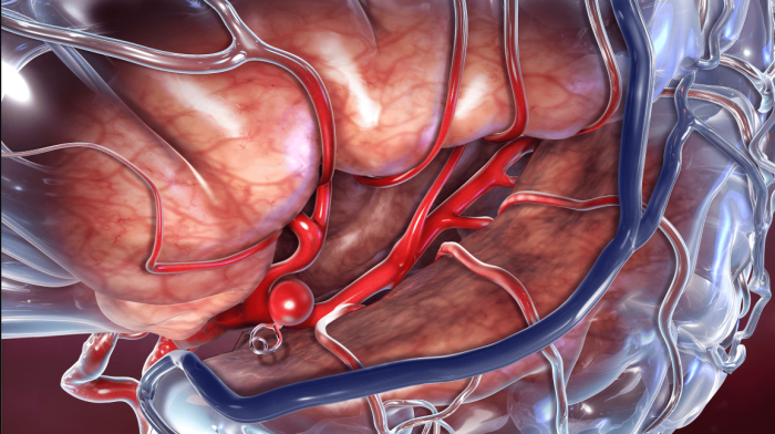 Understanding Aneurysm Surgery: What to Expect Post-Operation