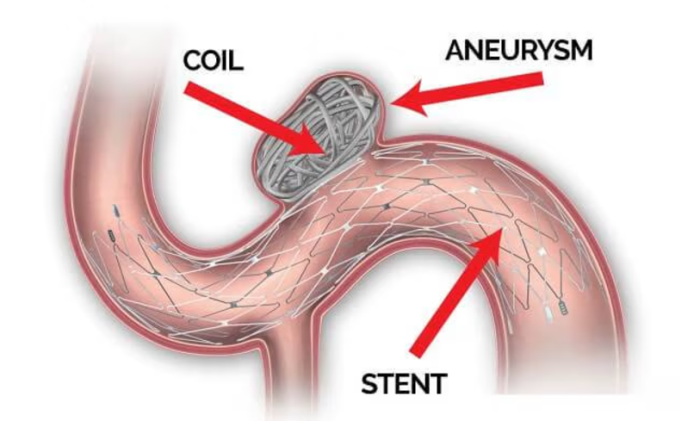 Endovascular Coiling: A Minimally Invasive Approach