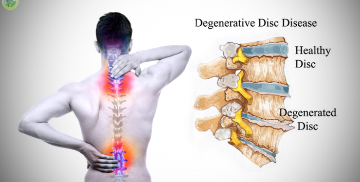 Degenerative Disc Disease: When Surgery Becomes Necessary