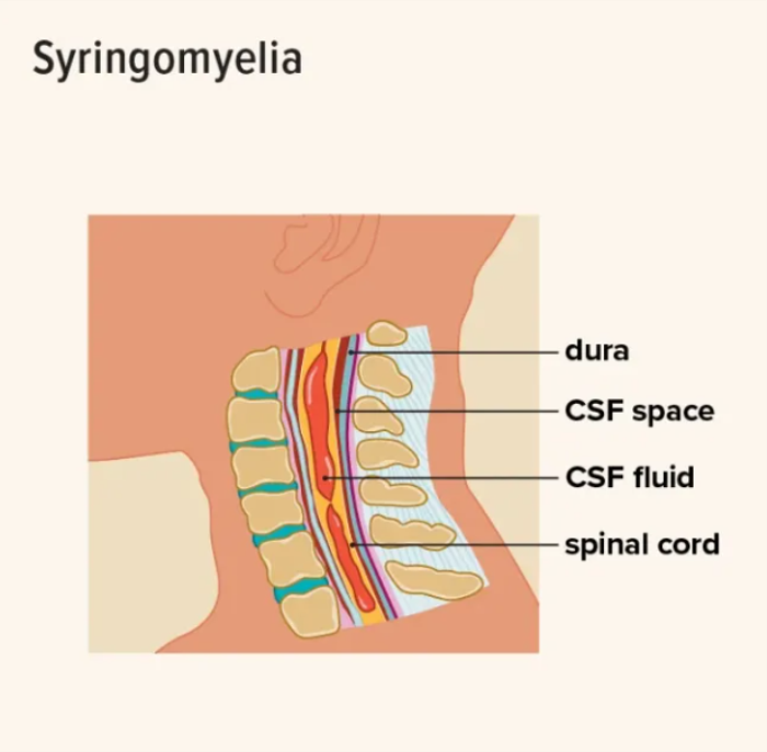 Syringomyelia: Surgery for Fluid-Filled Cysts in the Spinal Cord